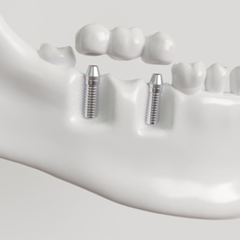 Illustration of dental implant bridge for lower arch