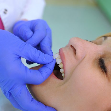 veneer being attached to a female patient’s tooth 