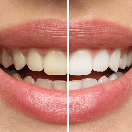 Close up of a smile demonstrating tooth color before and after whitening