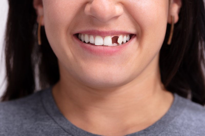 Patient smiling with a missing tooth